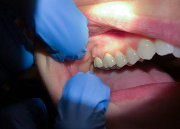 Best Emergency Treatment for Dental Infections or Abscesses in Brookfield, IL