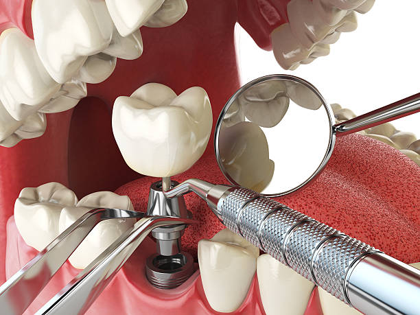 Best Emergency Tooth Extraction in Brookfield, IL